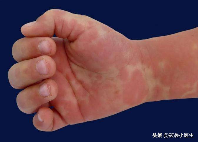 少儿川崎病,川崎病是什么样子的儿童