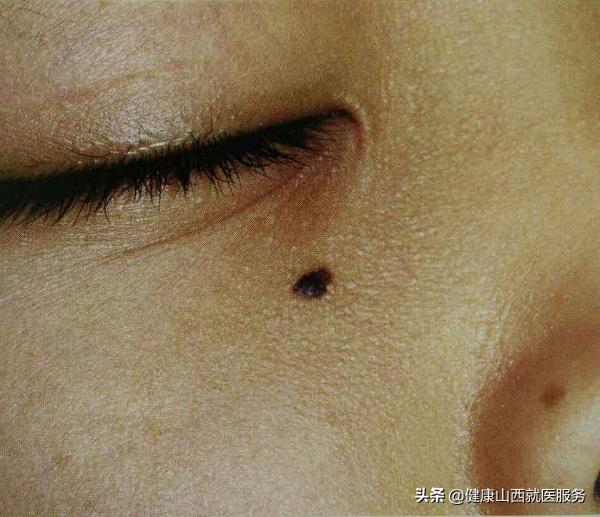 激光祛比较大的痣会癌变吗,为什么激光祛痣还会长出来
