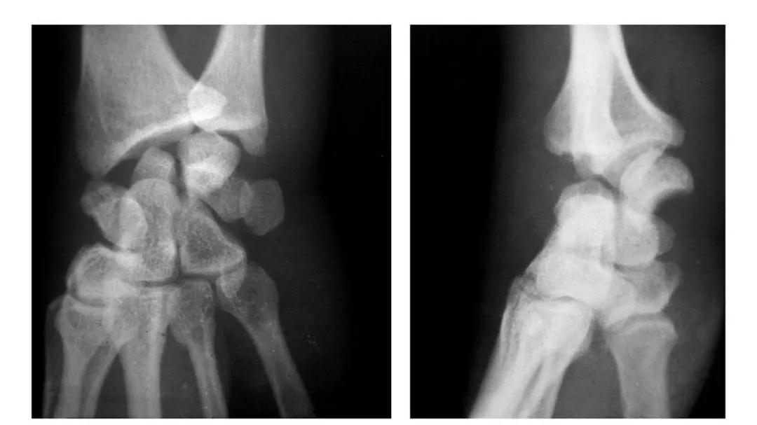 青少年肘部损伤最常见的是,肘部桡神经损伤的临床表现