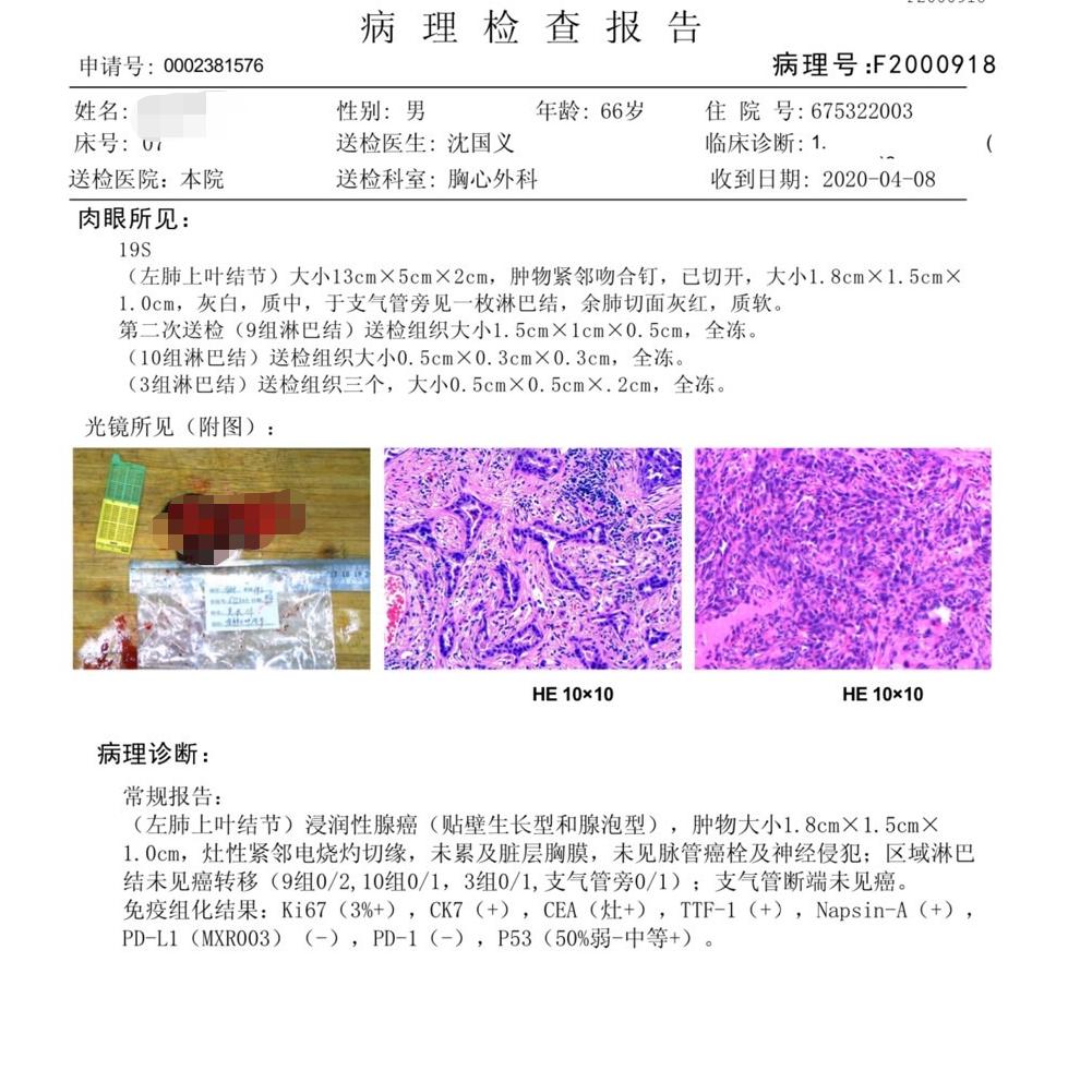 肺结节楔形切除术需要定位吗,肺结节微创术前定位有辐射吗