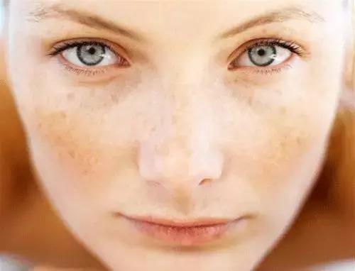 只需3步淡化斑点,简单4招快速淡化色斑
