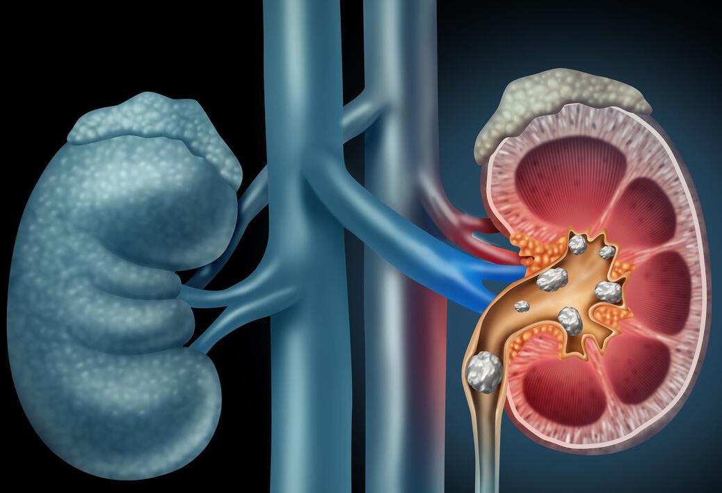 输尿管结石医生说不用手术可行吗,胆囊结石用不用手术