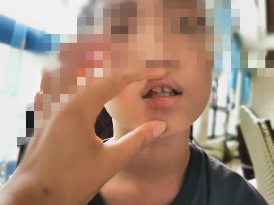 夏令营把牙齿摔了,夏令营孩子受伤谁的责任