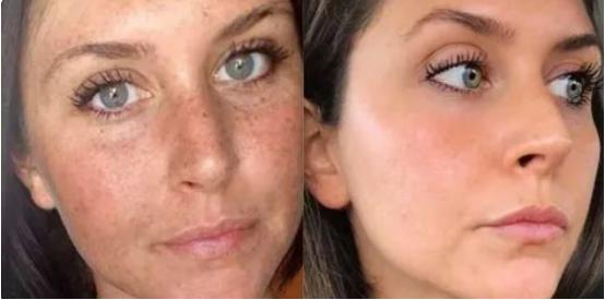 国际上有根除遗传雀斑的方法吗,专业祛斑四天根除遗传性雀斑