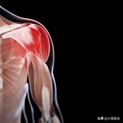 肩肌炎严重吗,从肩到后背疼痛是什么原因