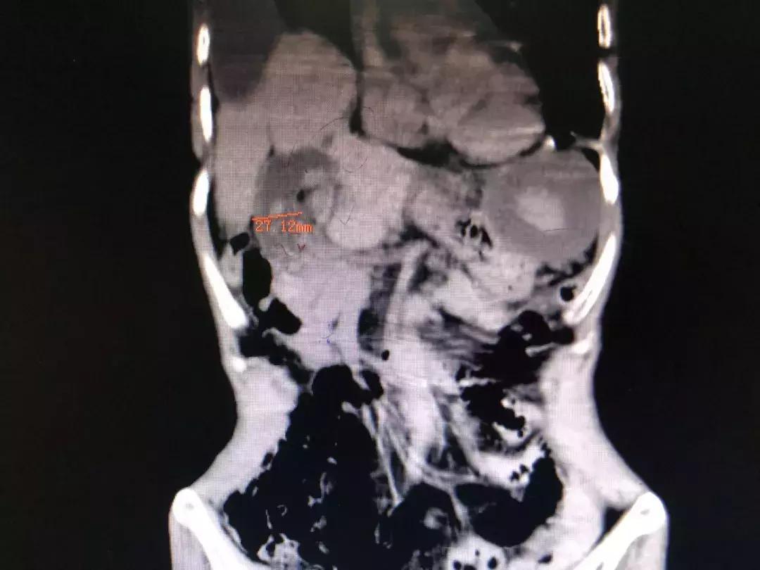 膈肌破裂修补术是大手术吗,膈肌缺损手术