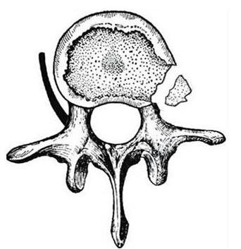 膨出型突出型脱出型游离型分类,腰椎间盘膨出和腰间盘突出的区别