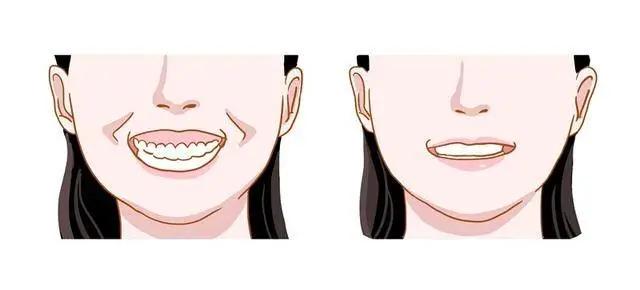 牙齿是深覆合必须要矫正吗,深覆合是要矫正牙还是做正颌手术