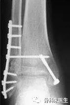 跟骨骨折保守治疗如何锻炼踝关节,小腿骨折术后可以做踝关节锻炼吗