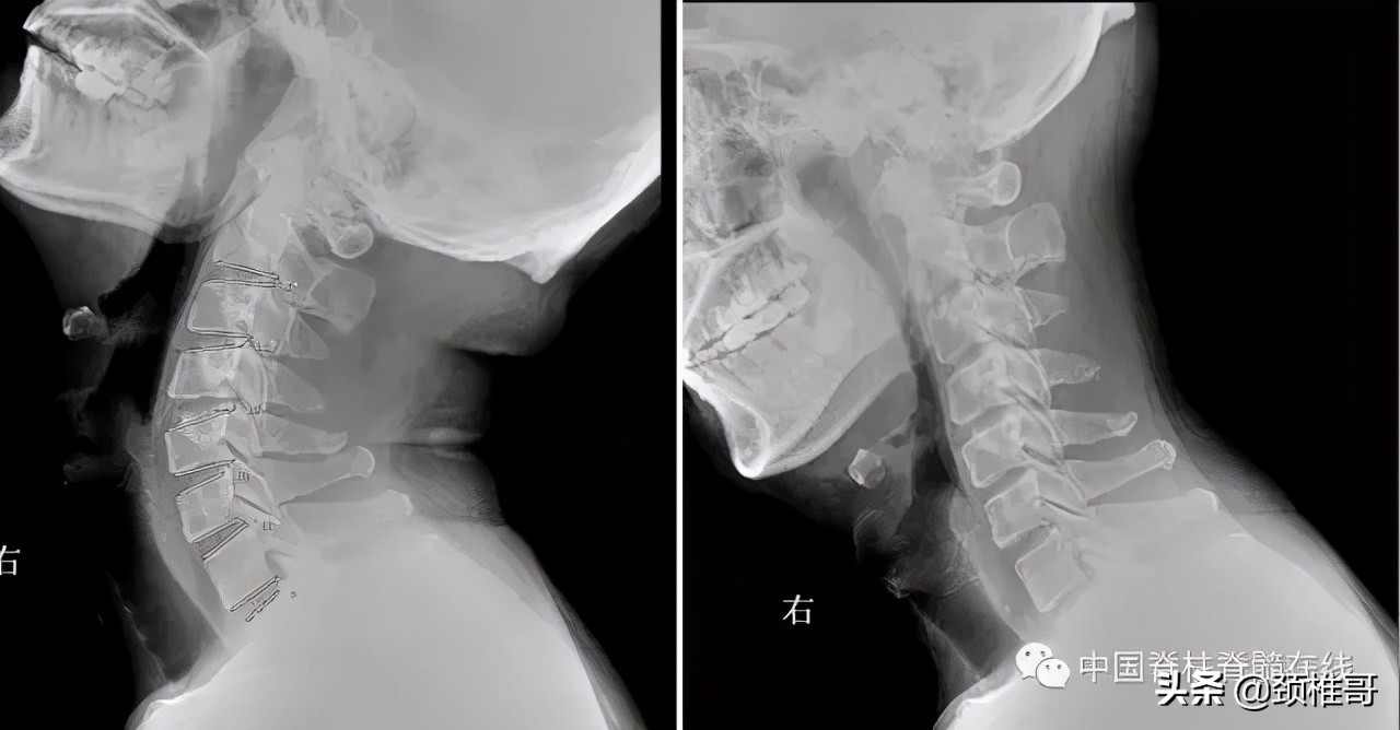颈椎病的护理临床路径流程图,颈椎病的健康管理与康复指导