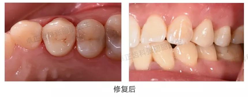 牙齿楔状缺损修复视频,牙齿缺损了可以选择哪些修复方式