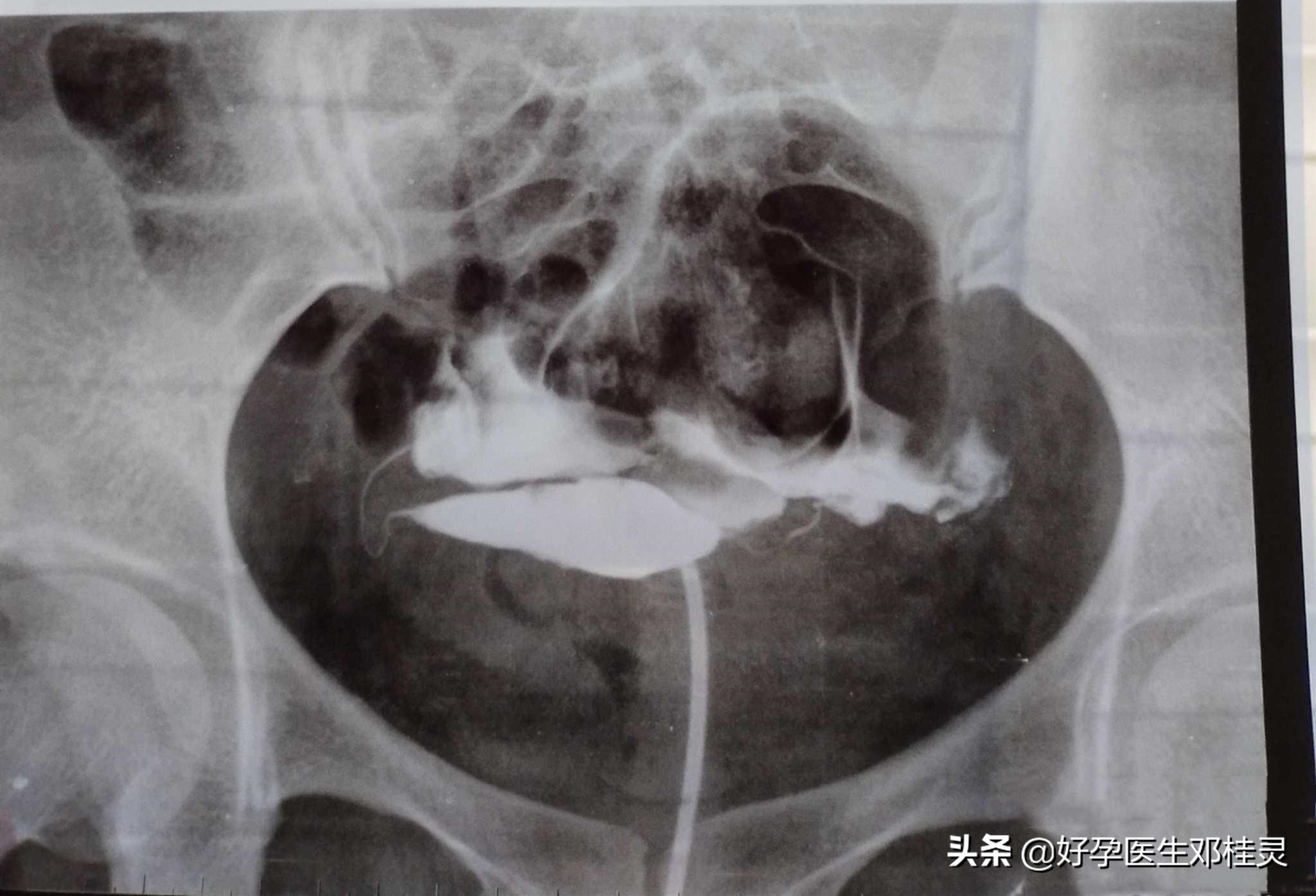 三胎备孕两年没怀孕检查都正常,三胎不孕用查免疫吗