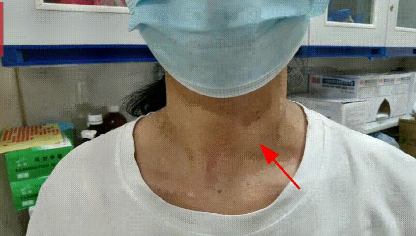 哈尔滨微创消融甲状腺结节哪家好,甲状腺结节微创消融术的过程