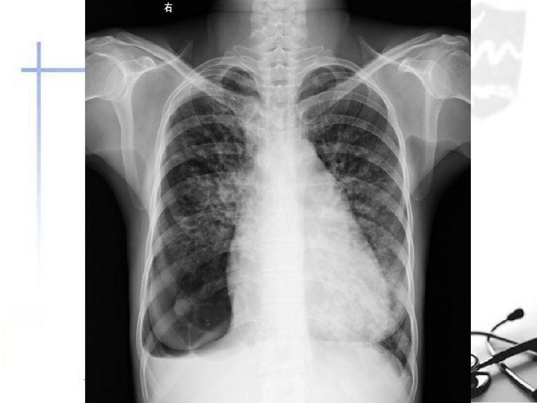 内侧副韧带损伤导致膝盖不能弯曲,膝关节外侧副韧带损伤不能伸直