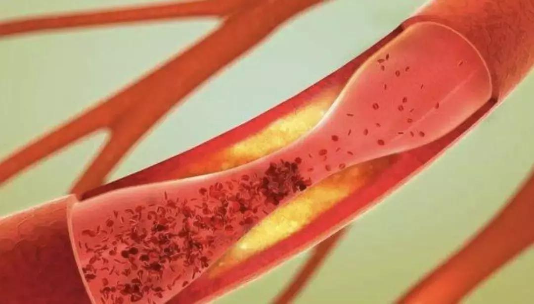 血管有杂质是什么症状,血管里有垃圾和毒素吗