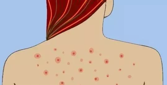 冬天怎么调养皮肤,如何改善后背长痘的问题