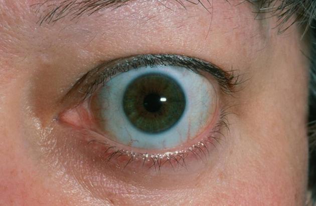 为什么甲亢吃得多不胖,吃得多又不长胖是病吗