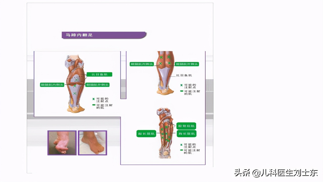 肉毒素治疗脑瘫患儿成功案例,肉毒素治疗脑瘫肌肉痉挛的效果