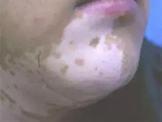 孩子脸花一块白一块怎么回事,小孩脸上花一块怎么回事