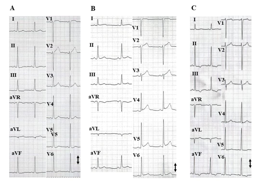心包炎和主动脉夹层的区别,急性主动脉夹层的发生原因是什么