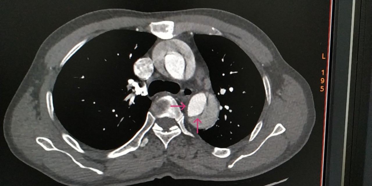 颠覆认知免费阅读全文,d-二聚体是检测什么