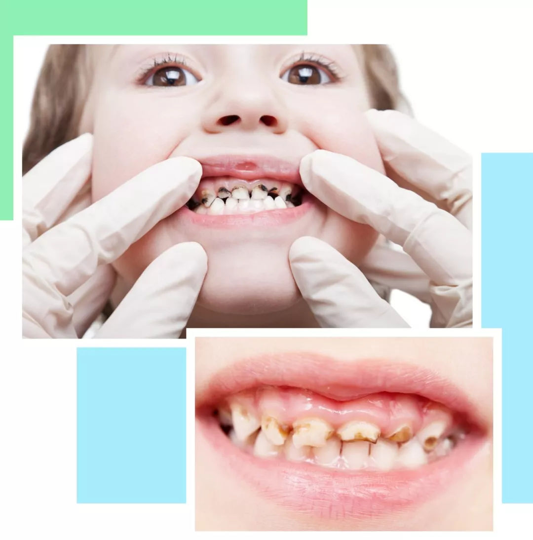 儿童牙齿变黑的原因和治疗的方法,6岁孩子牙齿变黑是蛀牙吗