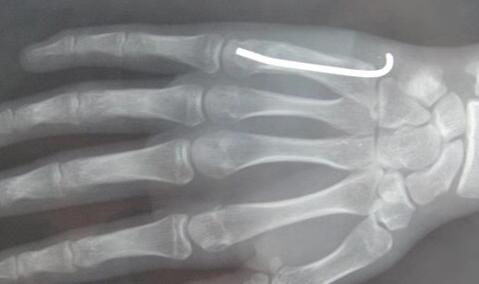 拳击手骨折手背凸起,了解什么是拳击手骨折