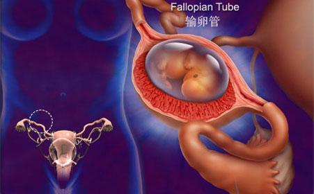 女性盆腔积液腹痛用什么药最好,女人之痛是什么