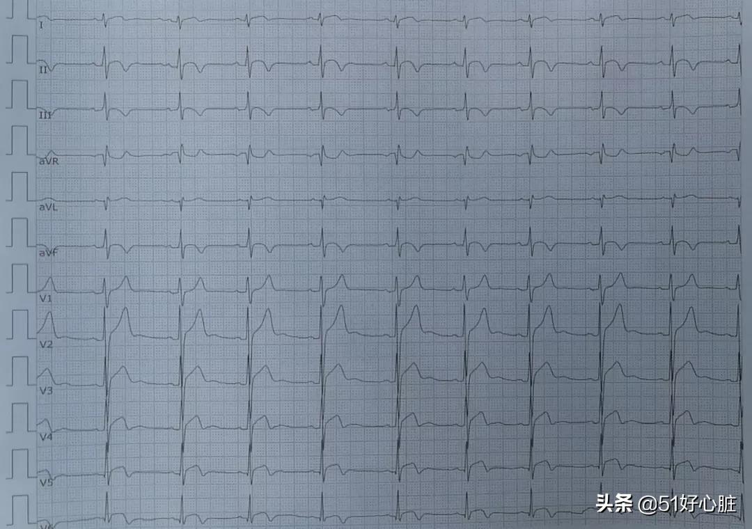 心肌酶高会引起胸闷胸痛吗,突发心肌梗塞是什么原因引起的