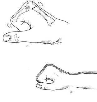拳击手骨折手背凸起,了解什么是拳击手骨折