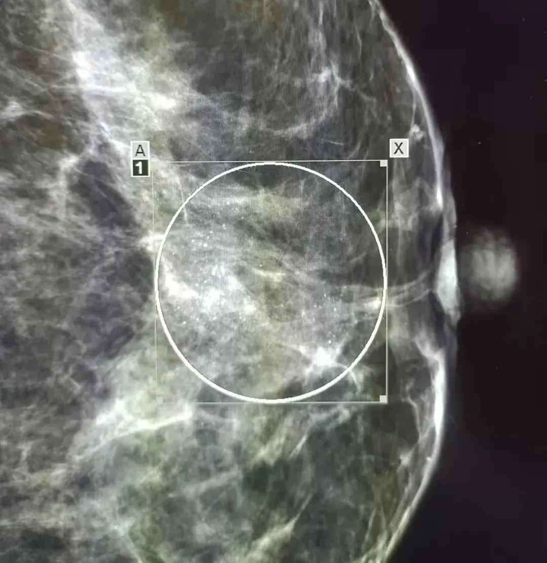 乳腺有毛刺形态不规则是恶性吗,乳腺肿块良恶性如何判断