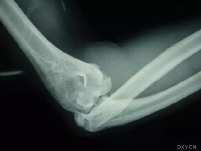 特殊骨折类型,特殊骨折体征