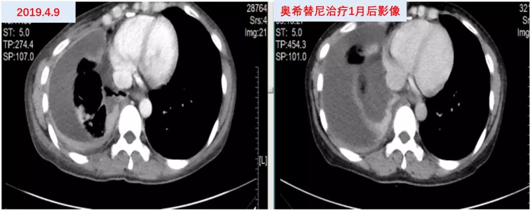 口服长春瑞滨出现耐药性了,口服长春瑞滨要吃多久