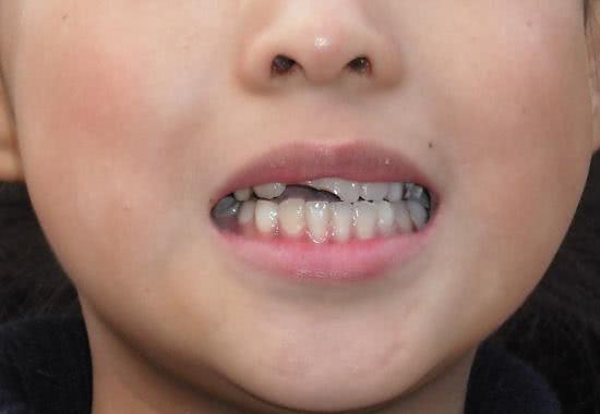 门牙摔断要马上根管治疗吗,门牙摔断一半能马上修复吗