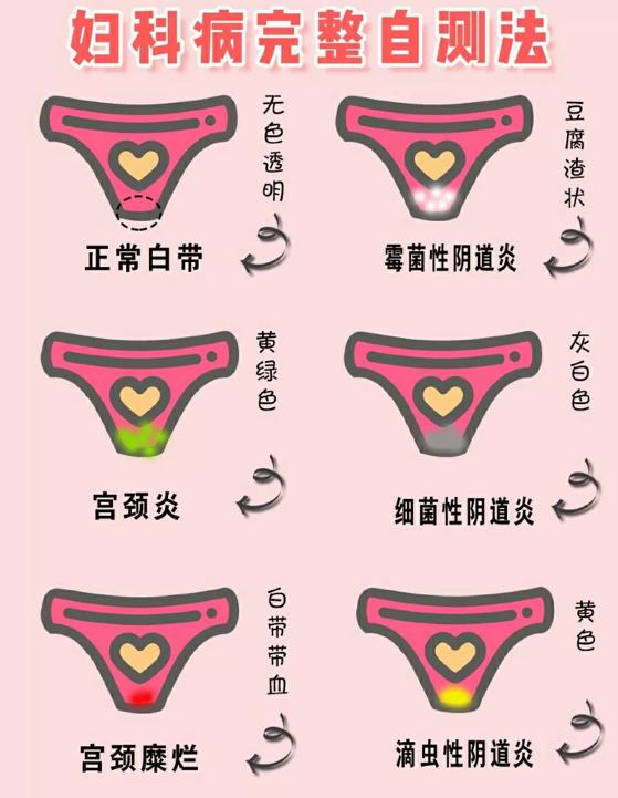 注意哪五个生活细节能预防盆腔炎,霉菌性阴道炎最怕三个症状