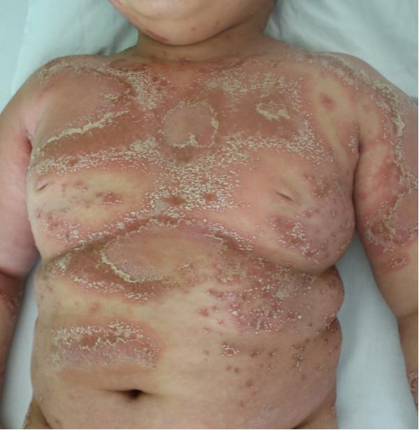 女儿得了银屑病怎么办,宝宝湿疹和银屑病区别