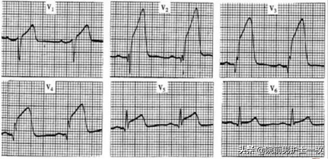 急性心梗的紧急处理视频,一旦发现急性心梗如何救