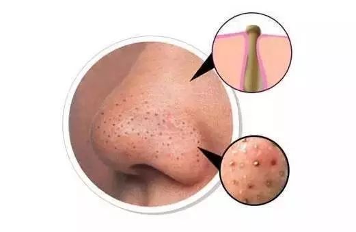 黑头可以用什么药膏来治疗,鼻子上的黑头怎么来的