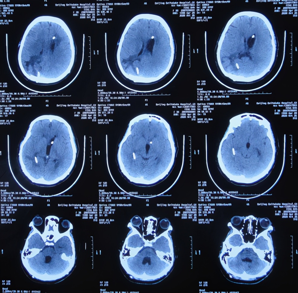 脑室有粘连脑积水有什么办法,脑动脉畸形手术后出现急性脑积水