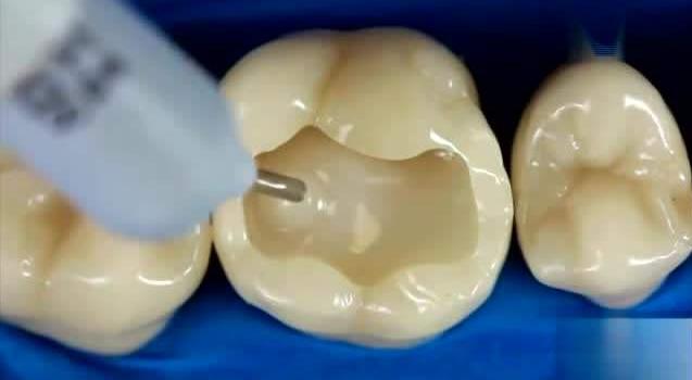 蛀牙不是病疼起来要人命,蛀牙只要不影响就可以不管