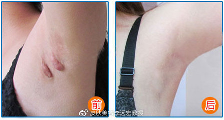 夏天疤痕治疗怎么做,夏季疤痕如何护理