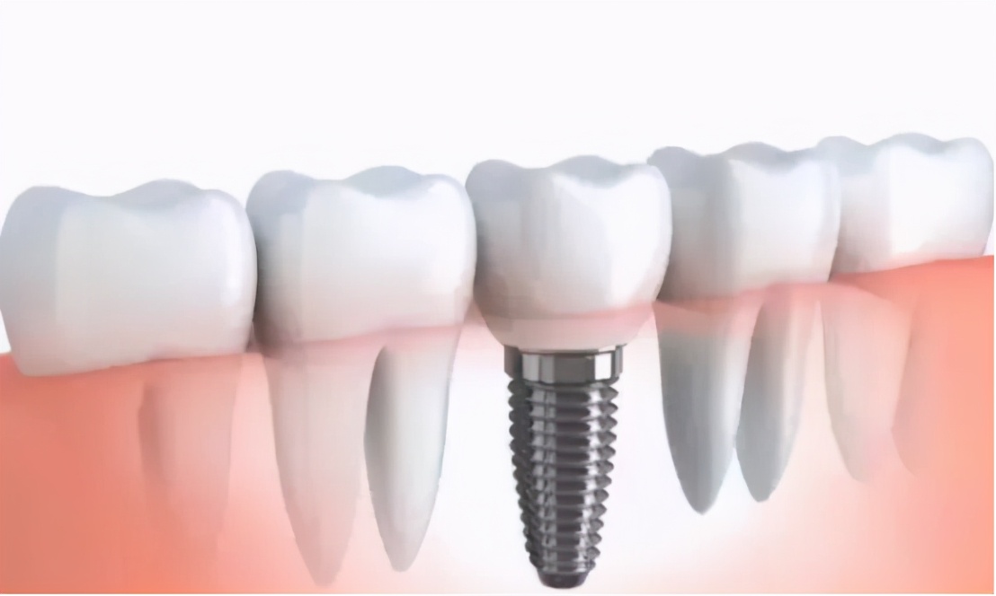 雅悦齿科杨浦雅洁口腔医院,雅悦齿科种牙