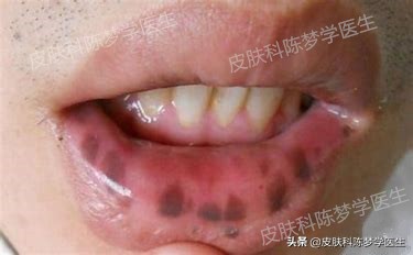 褐青色痣斑吃什么中药好,如何治疗脸上褐青色痣样斑