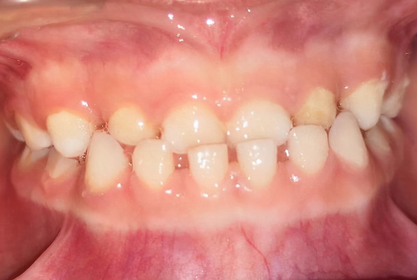 宝宝三岁半地包天矫正了三个月,17岁地包天牙齿反颌一定要矫正吗