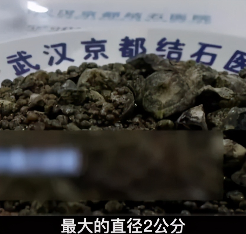 一男子体内取出224多颗胆结石,胆结石取出500个