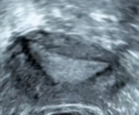 四维超声能看出宫腔粘连吗,做超声能看出来宫腔粘连吗