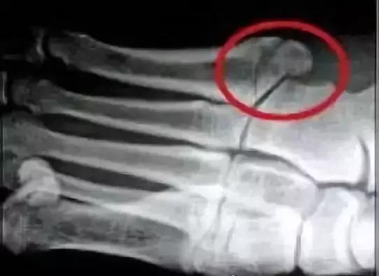 足球常见伤,足球中常见的运动损伤处理