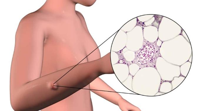 长脂肪瘤是什么引起的,脂肪瘤有什么危害脂肪瘤最怕什么