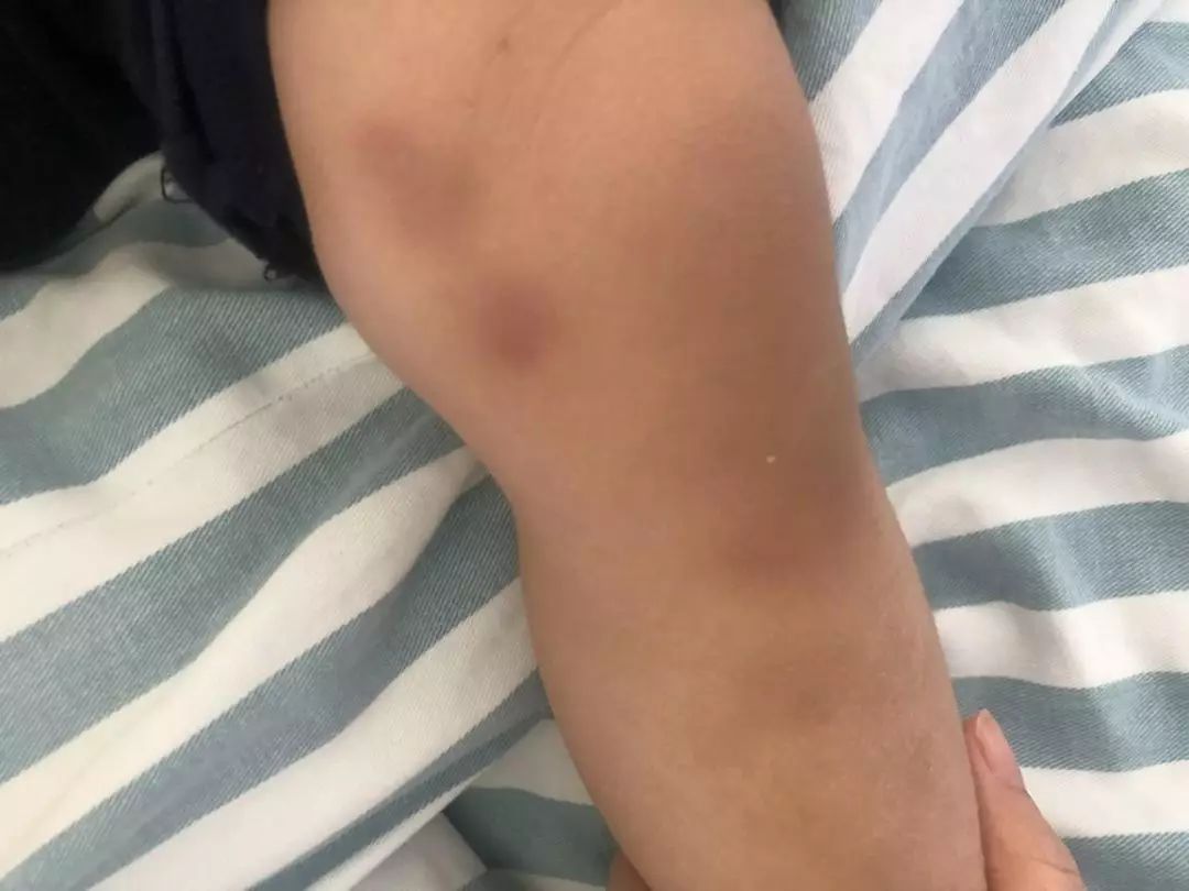 2个娃身上突然多处淤青，到底是谁虐的？