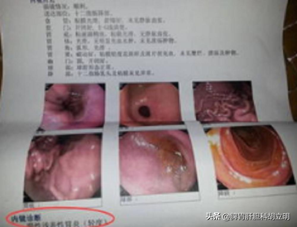 得了胃溃疡应该怎么处理呢,得了胃溃疡应该怎么办